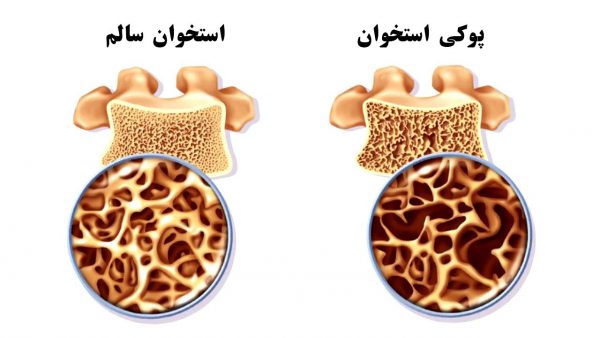 پروتئین و بیماری‌ها | پوکی استخوان